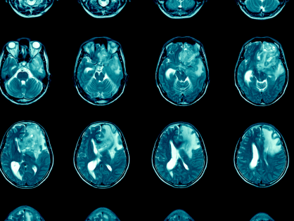 Analysis of PD-L1 and CD3 Expression in Glioblastoma Patients and Correlation with Outcome: A Single Center Report