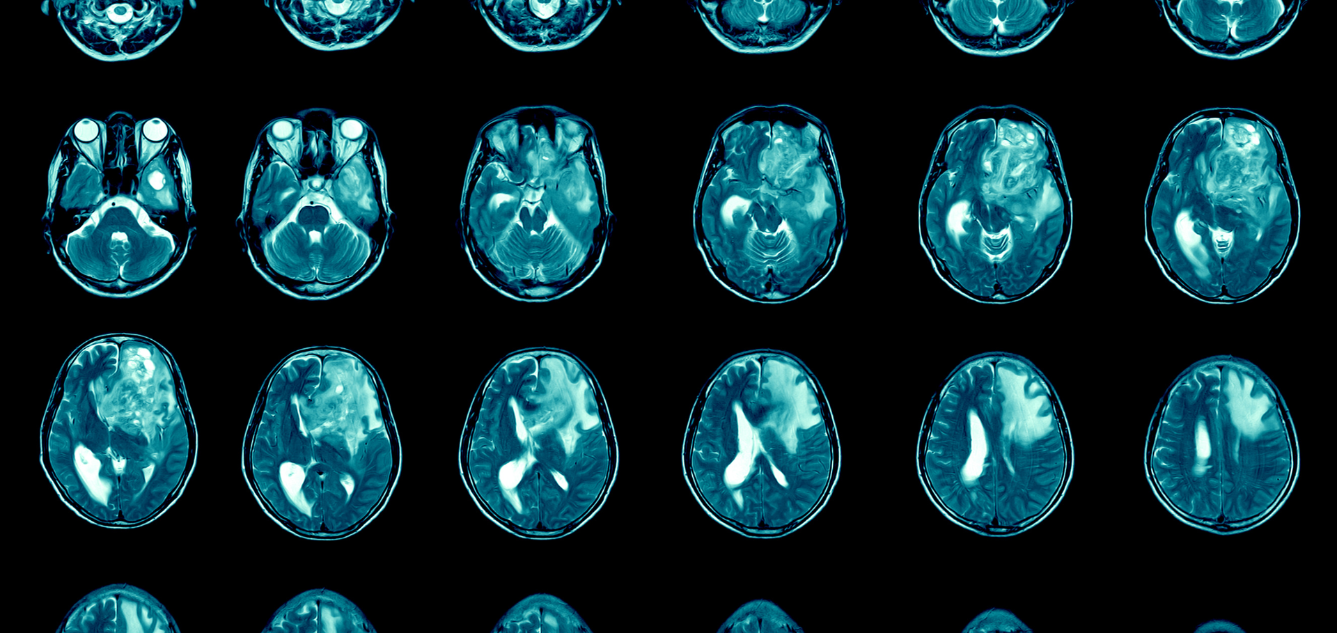 Analysis of PD-L1 and CD3 Expression in Glioblastoma Patients and Correlation with Outcome: A Single Center Report